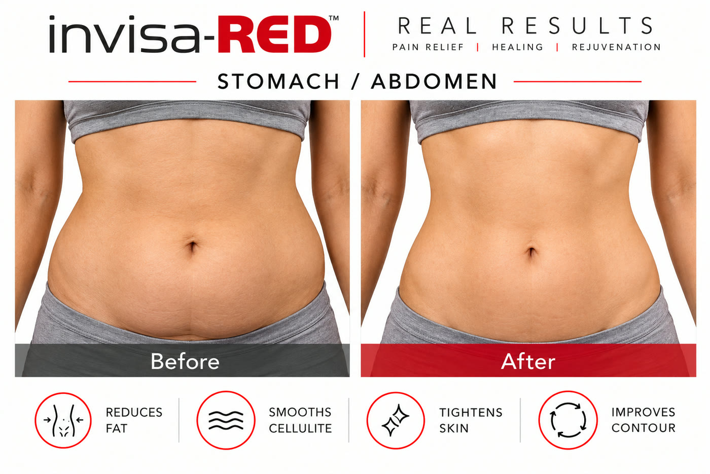 InvisaRED before and after: stomach and abdomen showing reduced fat, smoother skin, and improved contour